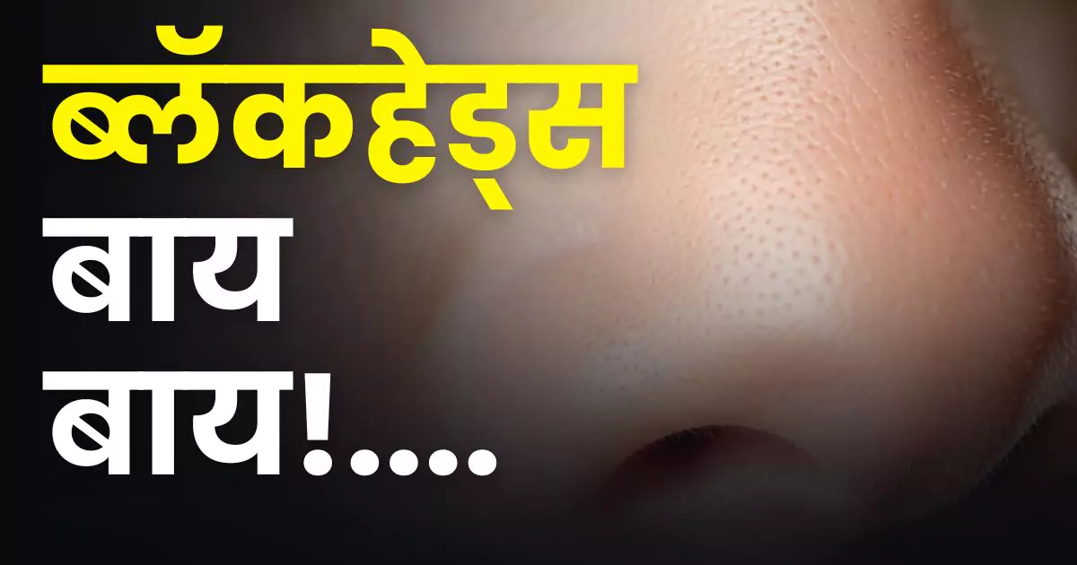 Blackheads removal at home